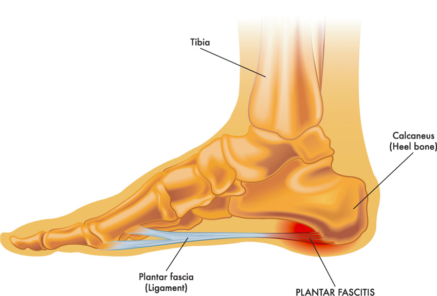 laser treatment for plantar fasciitis cost