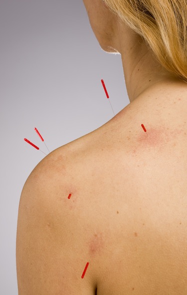 Acupuncture Chicago, Pinched Nerve Pain Relief